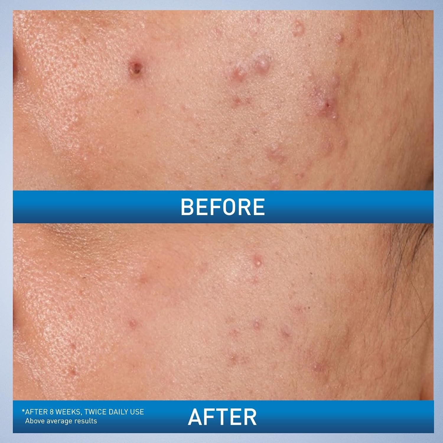 CeraVe Acne Control Gel (40ml) - Image 2